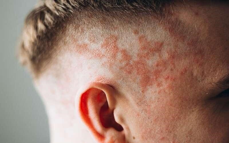 این مشکل پوستی شایع چرا نادیده گرفته می‌شود؟
