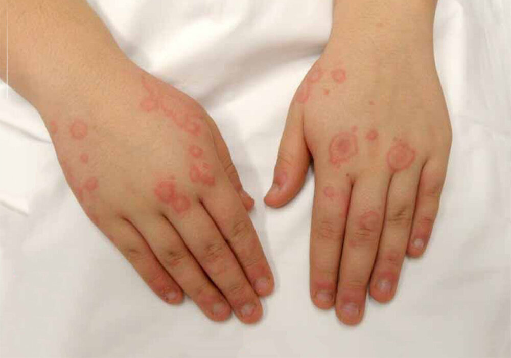 این بیماری در کودکان خطرناکتر است | چطور پیشگیری کنیم؟
