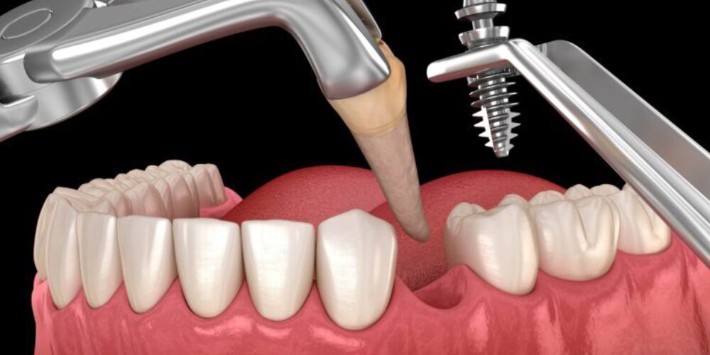 بررسی اجمالی انواع خدمات ایمپلنت دندان و مقایسه قیمت‌های آن