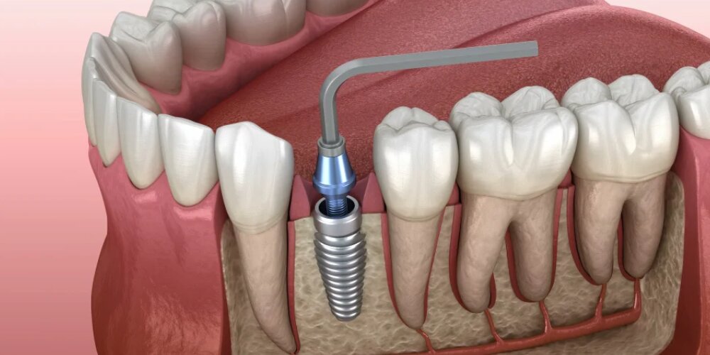 بررسی اجمالی انواع خدمات ایمپلنت دندان و مقایسه قیمت‌های آن