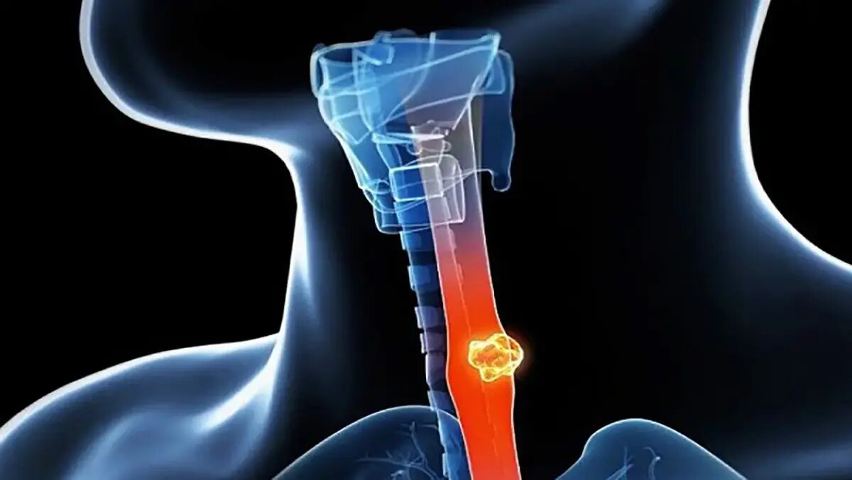 سرطان مری چیست؟ از علائم هشداردهنده تا روشهای نوین درمان