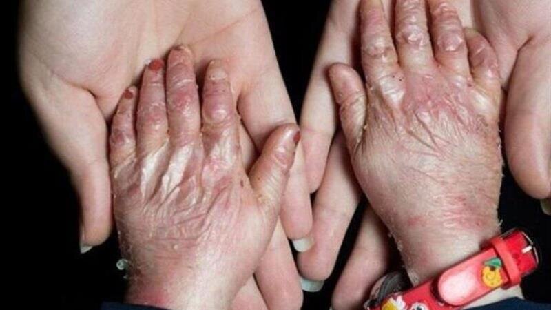 تقویت حمایتهای هدفمند و خدمات تخصصی از بیماریهای نادر در اولویت است