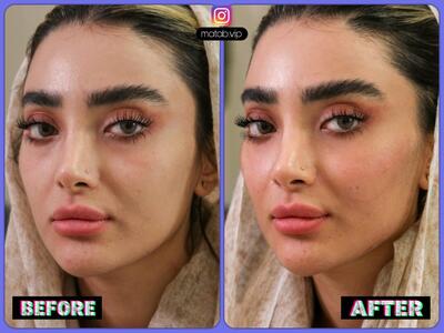  رازهای زاویه سازی فک و صورت : سفری به سوی زیبایی و تناسب چهره