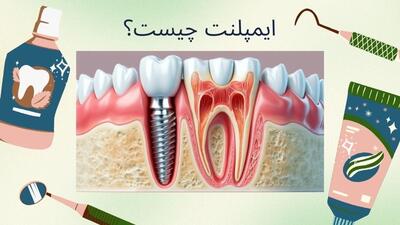  ایمپلنت دندان چیست و در چند مرحله انجام می‌شود؟