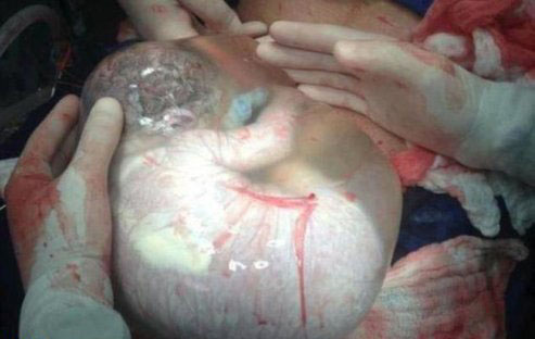 یک نوزاد درون کیسه آب، تولدی که نادر شد