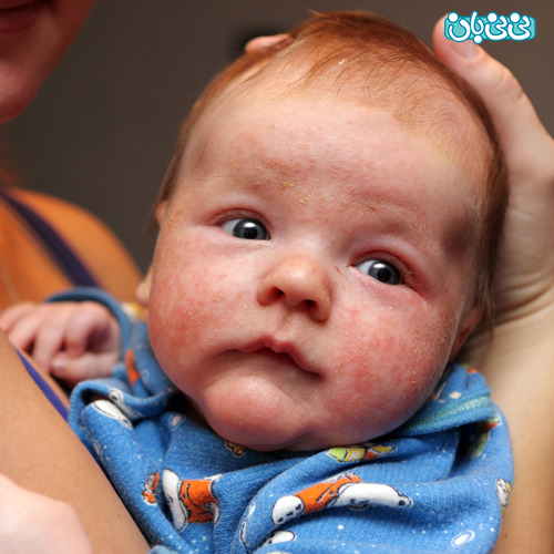 شیر مادر ابتلا به اگزما پوستی را کاهش می‌دهد؟