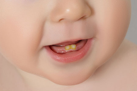 سیاه شدن دندان نوزاد، چاره چیست؟