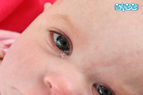 انسداد مجرای اشکی در نوزادان
