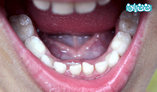 نامنظمی دندان کودکان