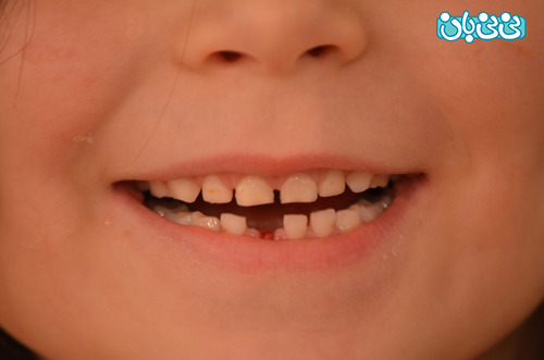 دندان شیری کودکان، توجه ویژه نیاز دارند