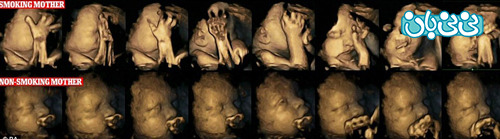 تصاویری از وحشت جنین هنگام سیگار کشیدن مادر