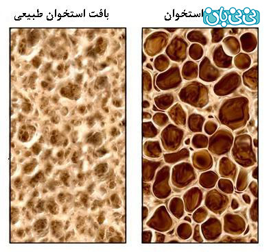 بد نشستن مهم‌ترين عامل پوكی استخوان