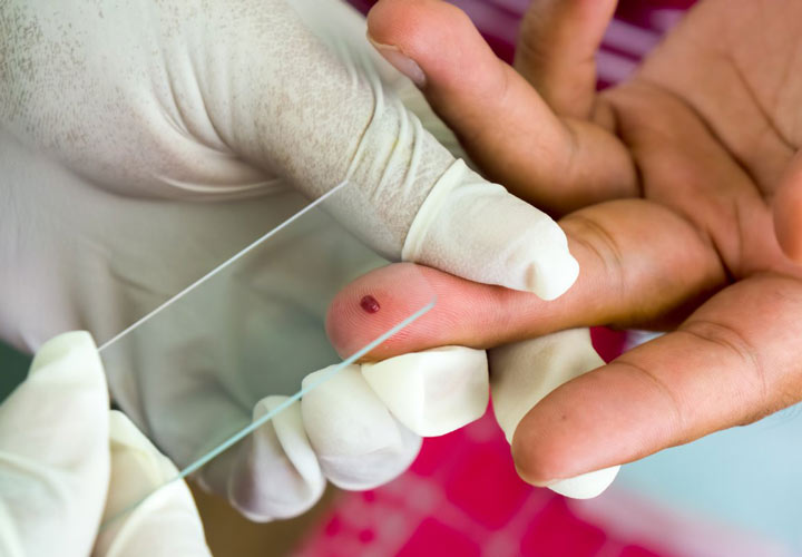 علل بیماری مالاریا، نشانه‌ها و درمان آن