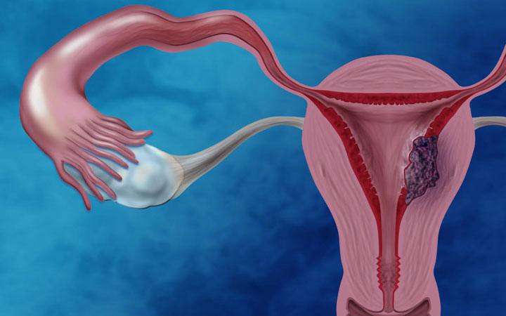 علائم سرطان رحم و روش‌های درمان آن | چطور