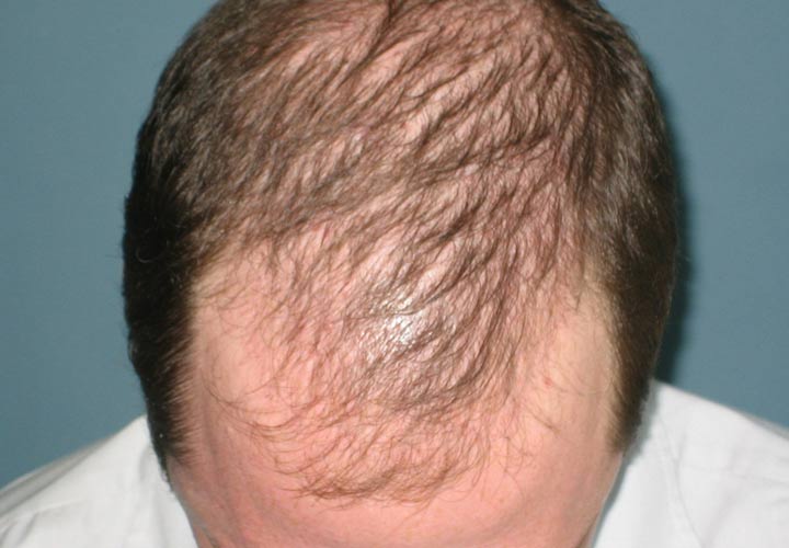 علت ریزش موی مردان و روش‌های درمان آن | چطور