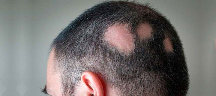 علت ریزش مو سکه ای (آلوپسی آره آتا)، راه تشخیص و درمان آن | چطور