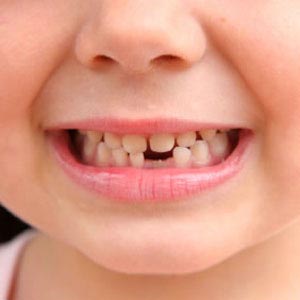 کودک و دندان های دائمی