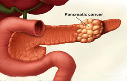 سرطان پانکراس نشانه ها, روش های پیشگیری, شناسایی, و درمان سرطان لوزالمعده