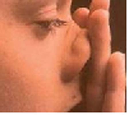 رینوکونژونکتیویت آلرژیک در کودکان