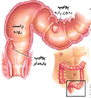 كدام پولیپ ها خطرناكند