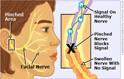 فلج بل Bells palsy با کودک چه می کند