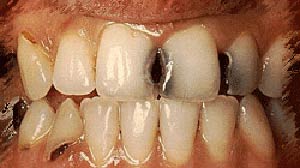 پوسیدگی دندان چرا و چگونه ایجاد می شود