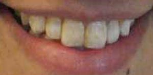 فلوئوروزیس دندانی Dental Fluorosis