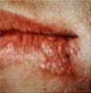 تب خال Cold sore