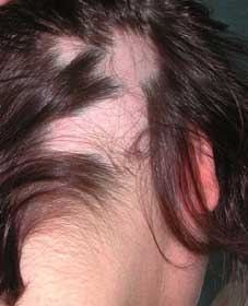 آلوپسی ریزش مو Alopecia
