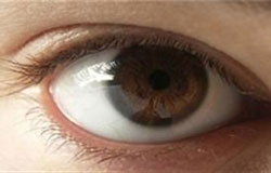 درمان انحراف چشم چیست
