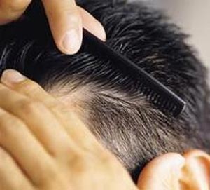 ریزش مو, علل و درمان