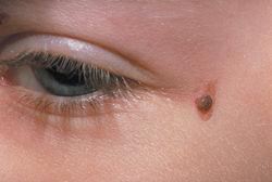 بررسی آسیب شناسی ضایعات پوستی با نمای زگیلی در بیماران پیوندكلیه