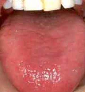 التهاب و قرمز شدن زبان گلوسیت tongue inflammation