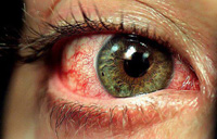 رایج ترین علل قرمزی چشم