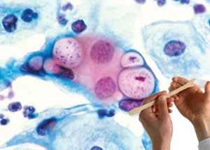 تشخیص زودرس یک سرطان زنانه