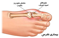 نقرس بیماری اغنیای سابق