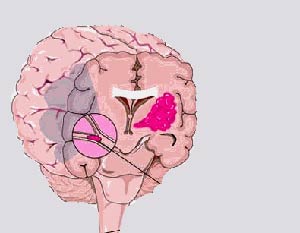 سکته مغزی ایسکمیک و سکته مغزی خونریزی دهنده