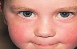 بیماری های پوستی شایع در کودکان