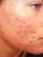 آكنه ACNE