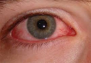 علل و علائم عفونت چشم چیست