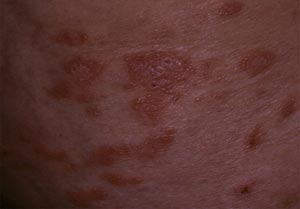 پسوریازیس Psoriasis