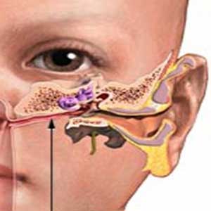 اوتیت مدیا Otitis Media التهاب گوش میانی