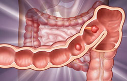 پولیپ های بدون نشانه روده