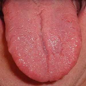 التهاب زبان گلوسیت