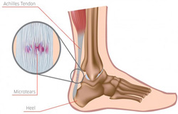 بهترین راه درمان پارگی تاندون ساق پا