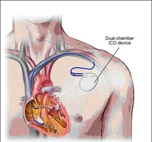 دفیبریلاتورهای قلبی کاشتنی ICD