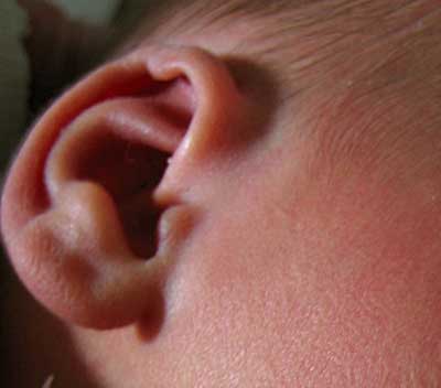 كم شنوایی در نوزادان