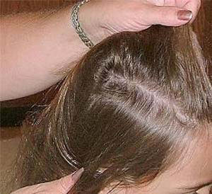 درمان ترکیبی ریزش موی ارثی