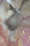 بررسی فراوانی عفونتهای قارچی گوش خارجی