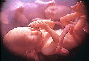 سقط مکرر جنین چرا و به چه علت